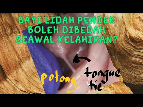 PENERANGAN TENTANG LIDAH PENDEK (TONGUE TIE) & LIP TIE